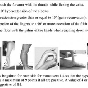 Original Beighton Score for hypermobility